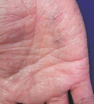 皮膚がんの見た目画像、初期症状、見分け方！特徴＆早期発見のコツ