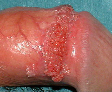 フォアダイス除去亀頭増大・長茎術・薬・サプリ・チントレなど