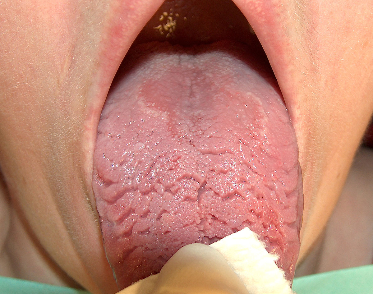 溝状舌 Fissured Tongue の原因と治療法