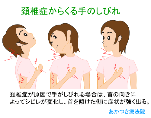 指のしびれ、「手根管症候群」かも 老化と勘違い - 日本経済新聞