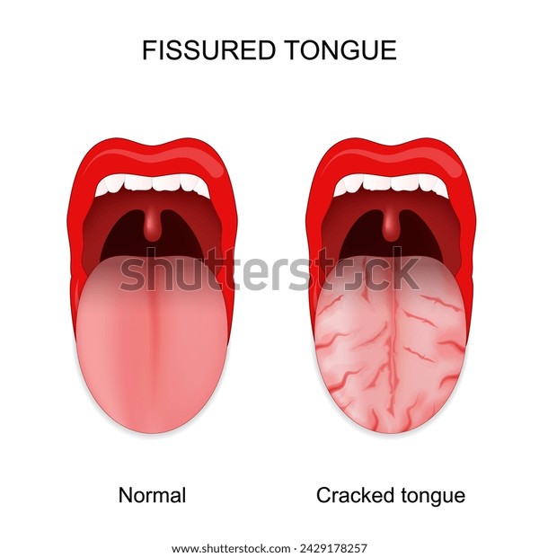 舌のひび割れはなぜ起きる？原因と対処法について徹底解説！ – ココシカ
