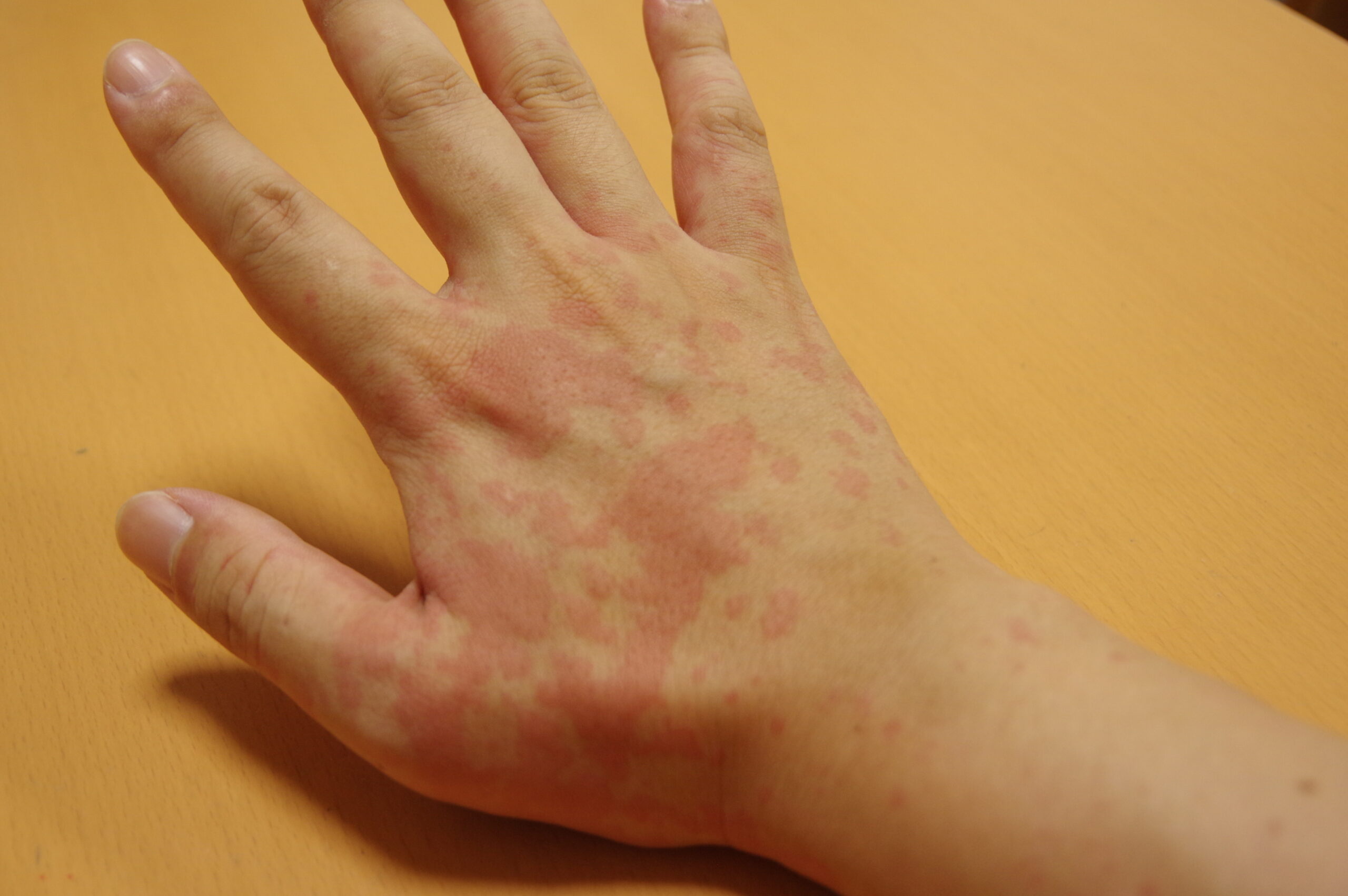 蕁麻疹 ジンマシン治療と運動ATTiVO Body Care GYM アッティーヴォ・ボディケアジム