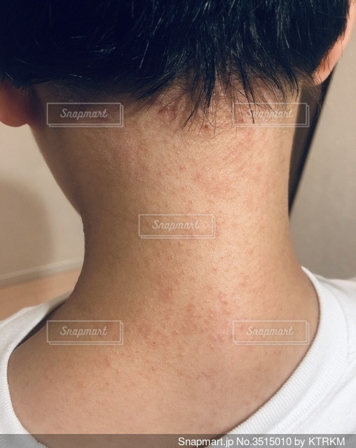 汗疹 あせも や汗かぶれの薬や治し方について 対策・ステロイドひまわり医院 内科・皮膚科