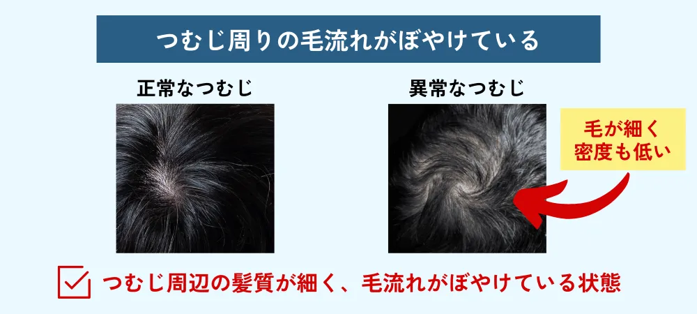 高校生です。このつむじは普通ですか？つむじ周りの髪の毛が他の- Yahoo!知恵袋