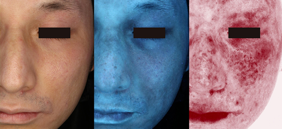 湘南の「選べる」シミ取り放題 シミ治療・レーザートーニング 医療レーザー外来なら湘南美容クリニック 公式