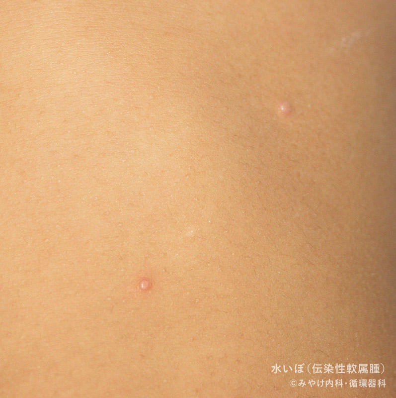 みずいぼ – お知らせ高木皮膚科・漢方皮膚科