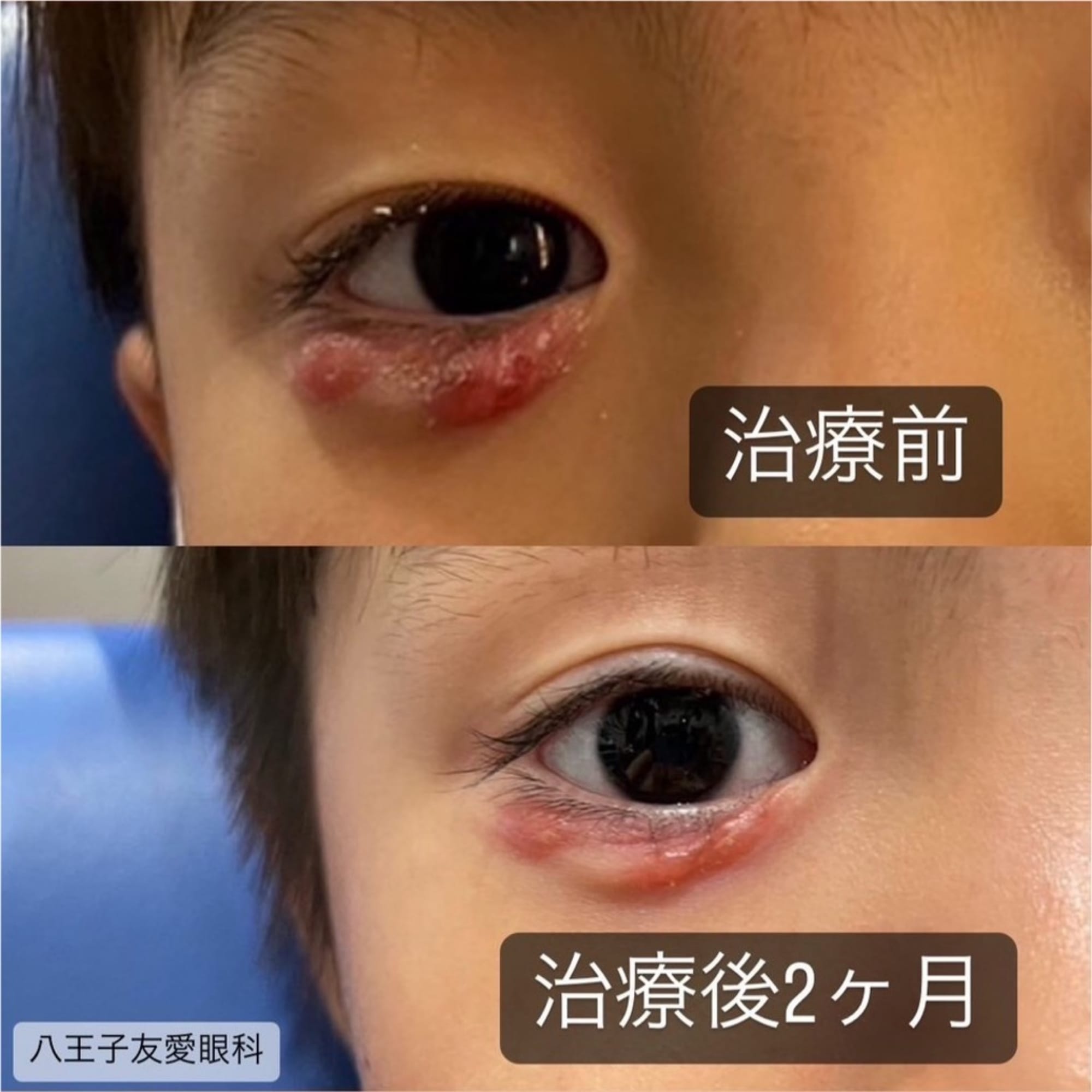 小児科医監修 子ども 赤ちゃん・幼児 のものもらいの種類・症状・治療法！プールには入れる？保育園・幼稚園・小学校は？ままのて