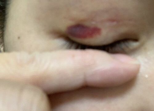 顔のまぶたが腫れている野田市 小児科 千葉県 こどもの花粉症 こどもの漢方 喘息 アトピー性皮膚炎 アレルギー 結節性痒疹 たんぽぽこどもクリニック