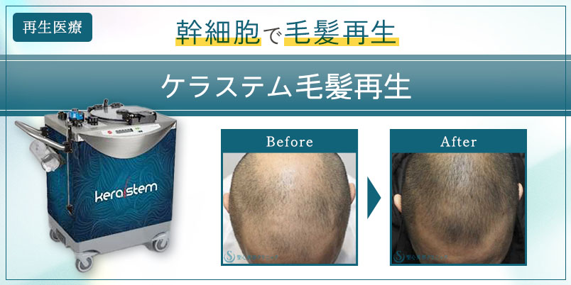 女性向け KERASTEM ケラステム 毛髪再生AGA・薄毛治療の 聖心毛髪再生外来