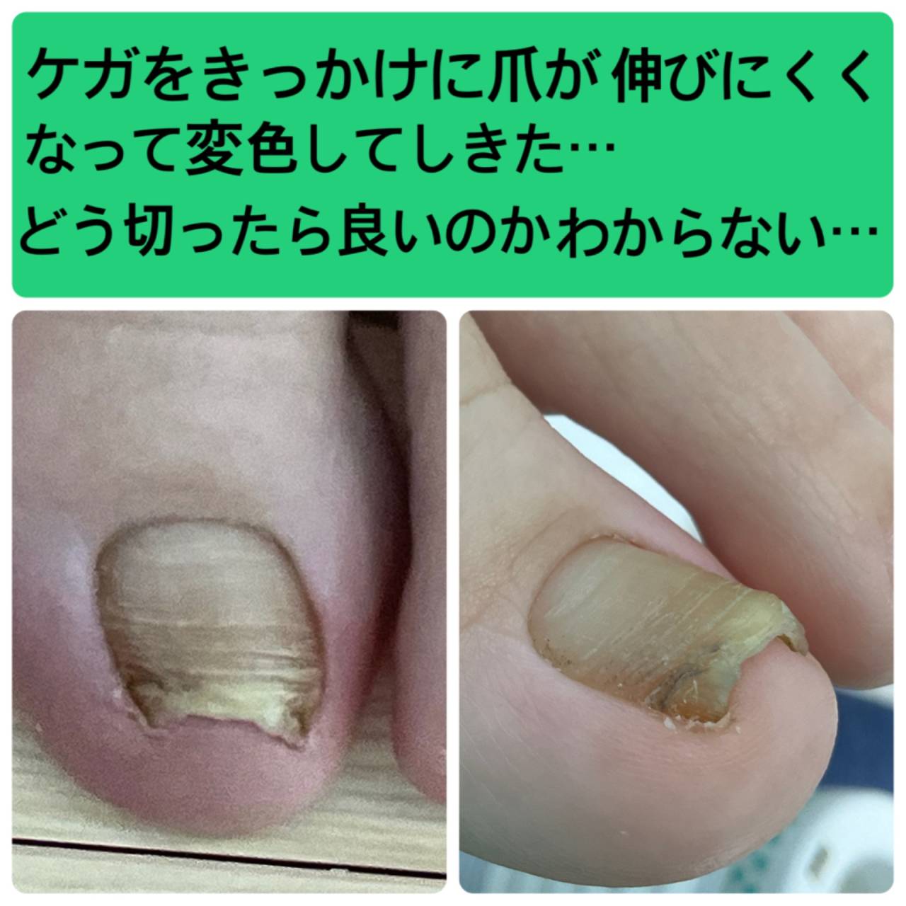 足の爪が厚い、白や黄色に変色する その原因は「爪白癬」かも！杉並区巻き爪矯正センタ
