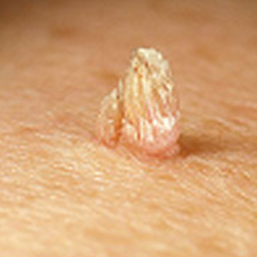 イボの見分け方・症状や原因 よくあるイボを6種類紹介 - 横濱もえぎ野クリニック 脳神経外科・脳神経内科