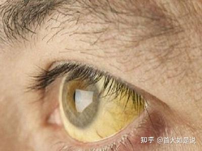 眼球旁边有黄色的东西怎么回事_39健康网