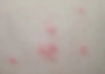 ダニによる感染症に注意しましょう！ 豊橋市