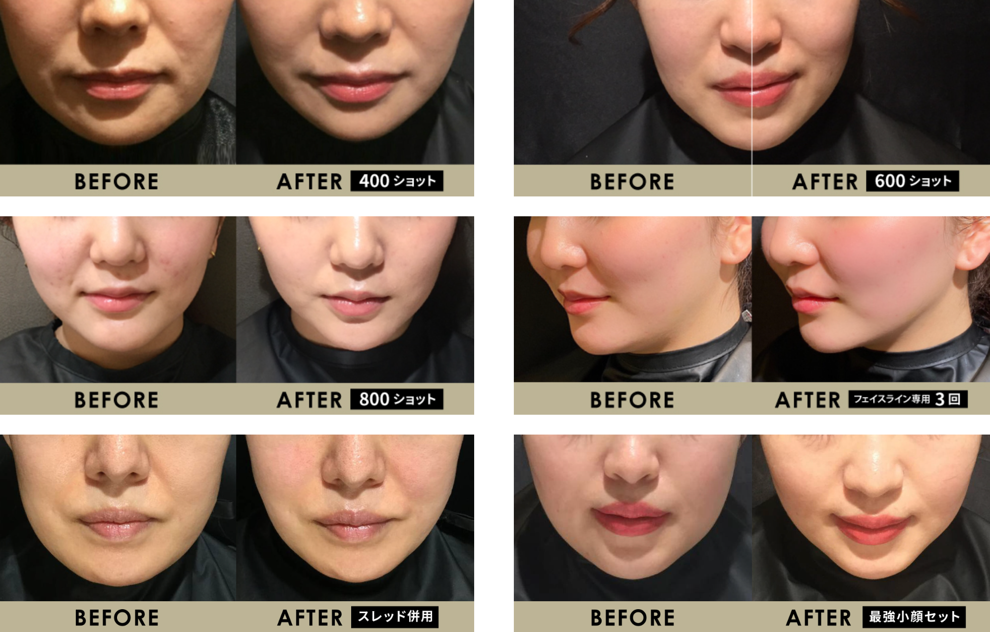 暴露 エステハイフは効果なし？医療ハイフとの違いを医師が解説 -ファイヤークリニック 医療ダイエット専門クリニック