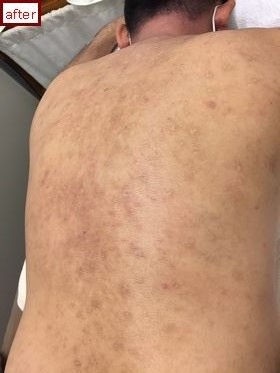 体のアトピー性皮膚炎の悪化に苦しんでいる子供の背中の上からの眺め。重度のアレルギー性発疹が小さな男の子の体を覆っていましたの写真素材・画像素材Image 191176641