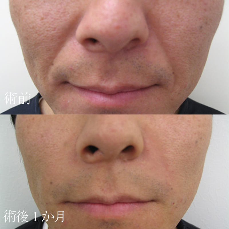 大阪のほうれい線ヒアルロン酸が上手い先生・名医と安いおすすめの専門クリニック - 医療脱毛専門美容皮膚科レナトゥスクリニック