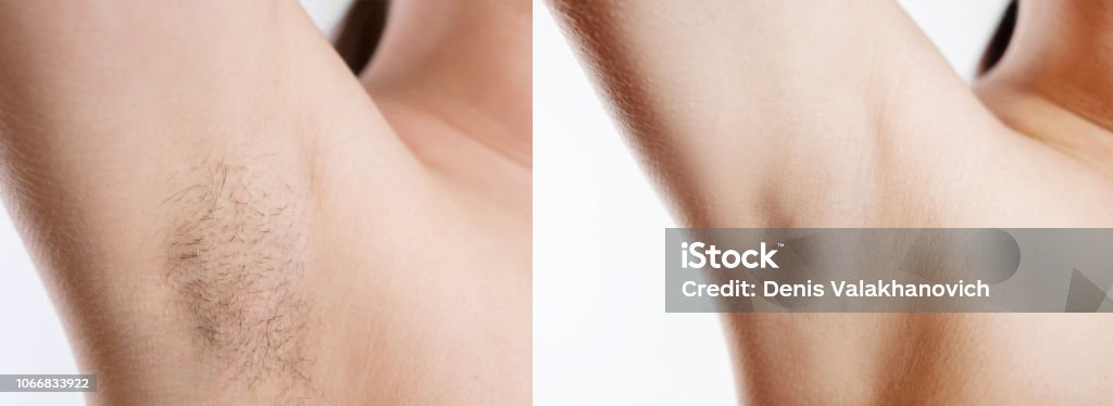 女性の医療脱毛 高校生の脇毛脱毛 症例写真- ヘアケアクリニック 六本木・福岡のAGA治療・注入療法