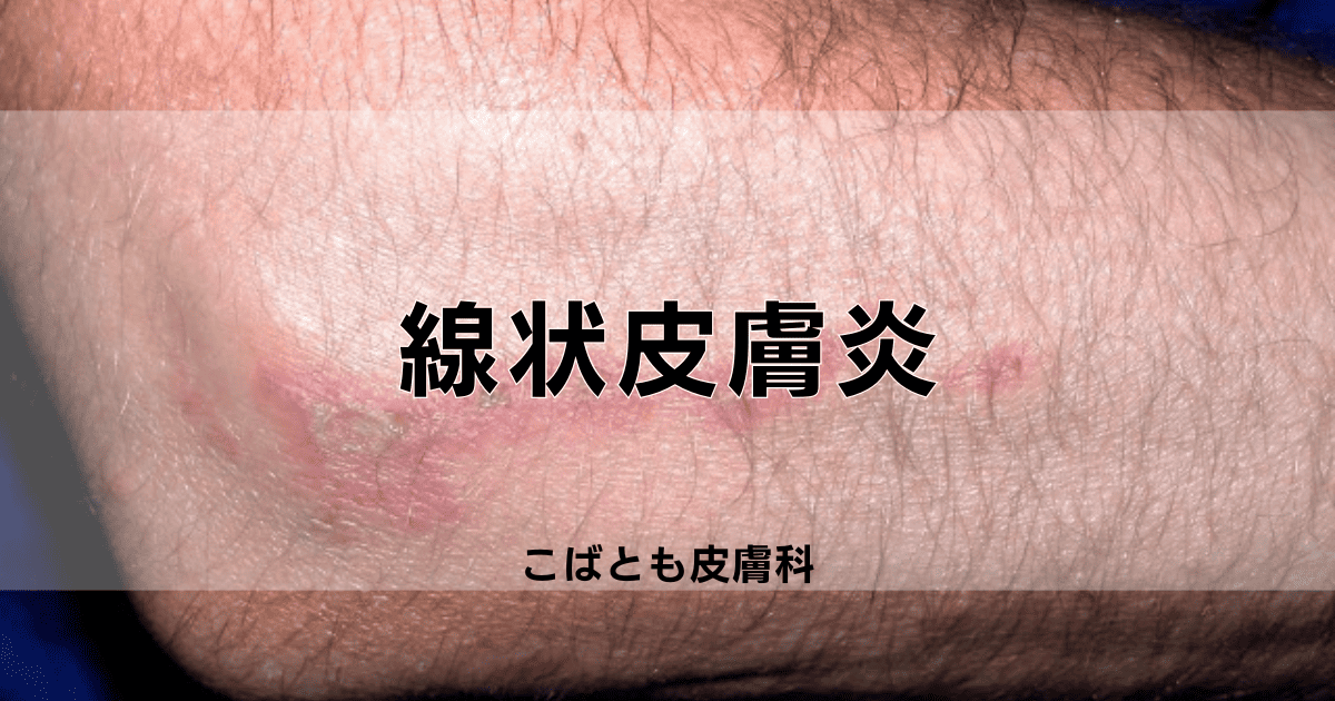 大人の蕁麻疹 じんましんよく見られる大人の病気 - みやけ内科・循環器科 家庭の医学