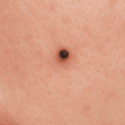 痛い！背中にできるできものの違いを形成外科専門医が解説 - 北海道皮膚のできものと粉瘤クリニック古林形成外科札幌院中央区大通にて皮膚悩みを土日祝も対応