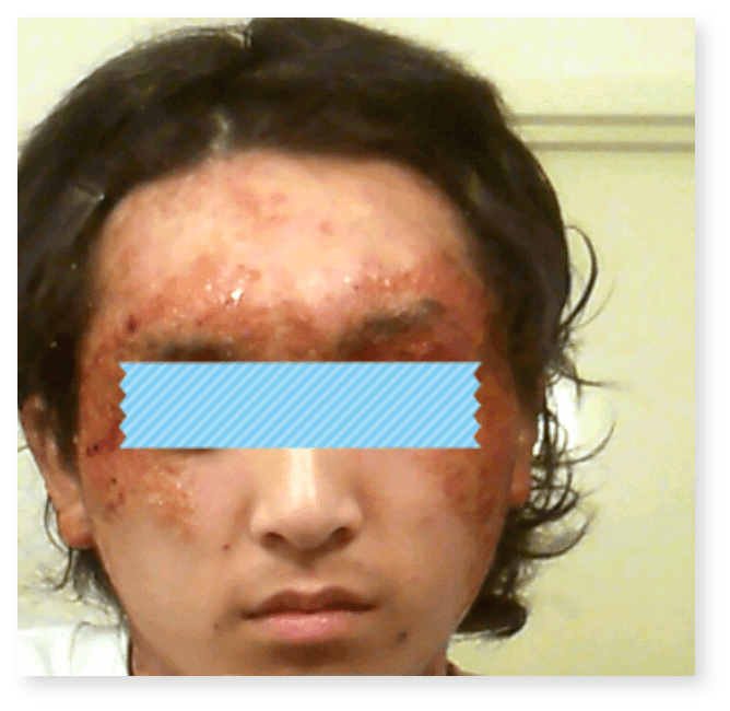 湿疹とは？原因と種類、ストレスからくる皮膚炎を画像で解説 - ヨクミテ医師監修の医療メディア