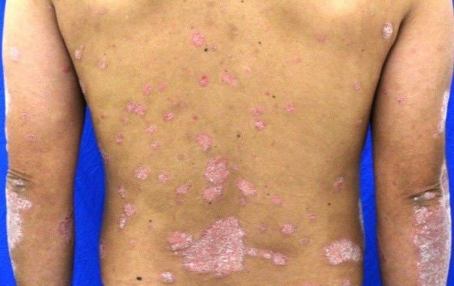 膿疱性乾癬 のうほうせいかんせん について乾癬 尋常性乾癬、乾癬性関節炎、膿疱性乾癬 の患者さん向けコセンティクス®を使用される患者さんへノバルティス ファーマ株式会社