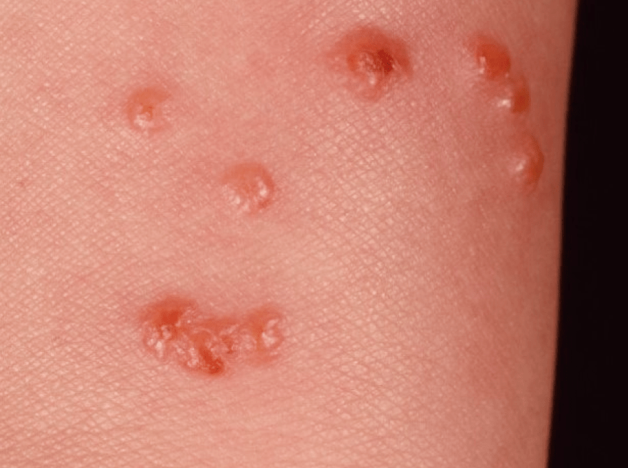 ブヨに刺されました。聖心美容クリニック 小林美幸Blog