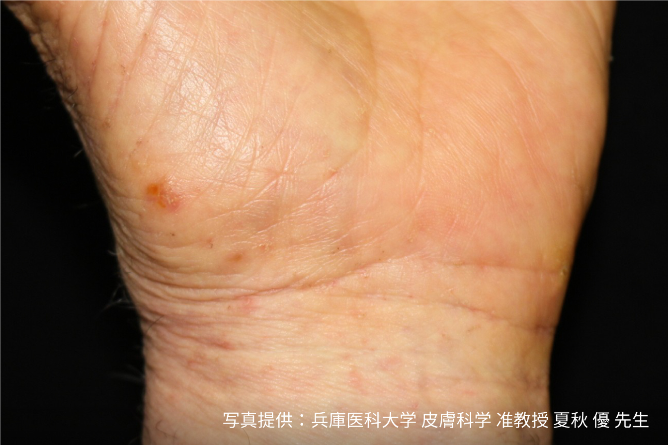 発疹・湿疹など症状写真あり ダニに刺された跡の特徴や症状・対策・あせもとの見分け方 - くらしのマーケットマガジン