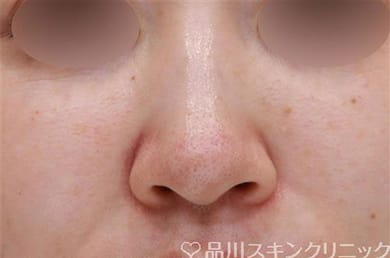 40代から始めるたるみ毛穴・帯状毛穴の徹底解消法美容皮膚科 銀座よしえクリニック 公式 東京
