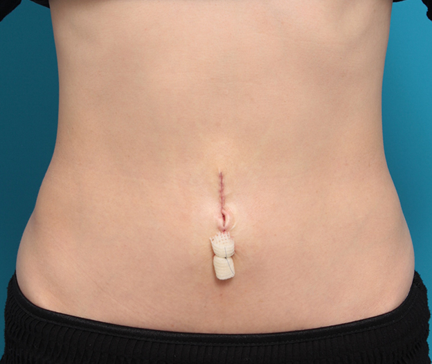 取るべき？ 残すべき？ どうしたらいい？ おへそのゴマの正しいケア法マキアオンライン美容雑誌『MAQUIA マキア 』公式ビューティサイト