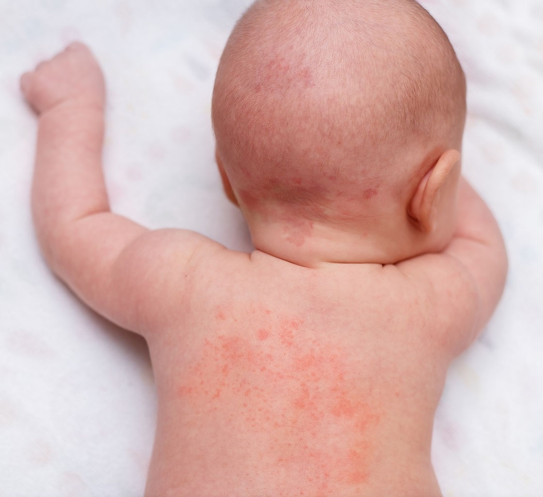 ストレスによる皮膚炎・湿疹の特徴は？アトピー悪化との関係や治し方を解説ふくろうの森クリニック 公式