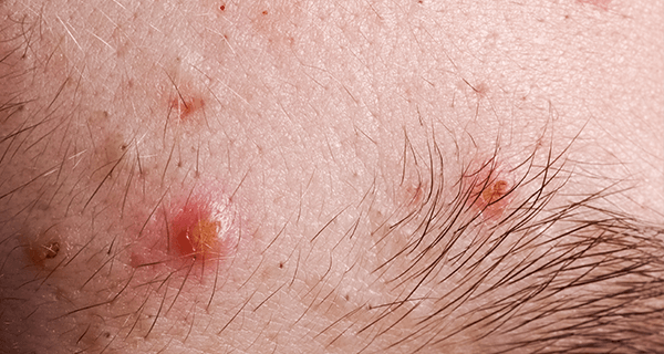 実証 右頬のニキビ・肌荒れを整えた1週間の過ごし方OKAOPLUS