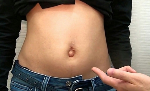 臍ヘルニア、大人のでべそALOHA外科クリニック