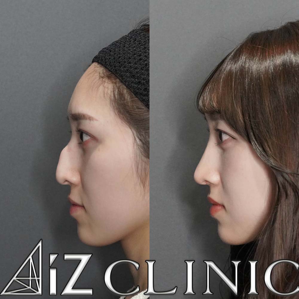曲がった鼻を美しく整える手術・斜鼻修正：美容外科 高須クリニック