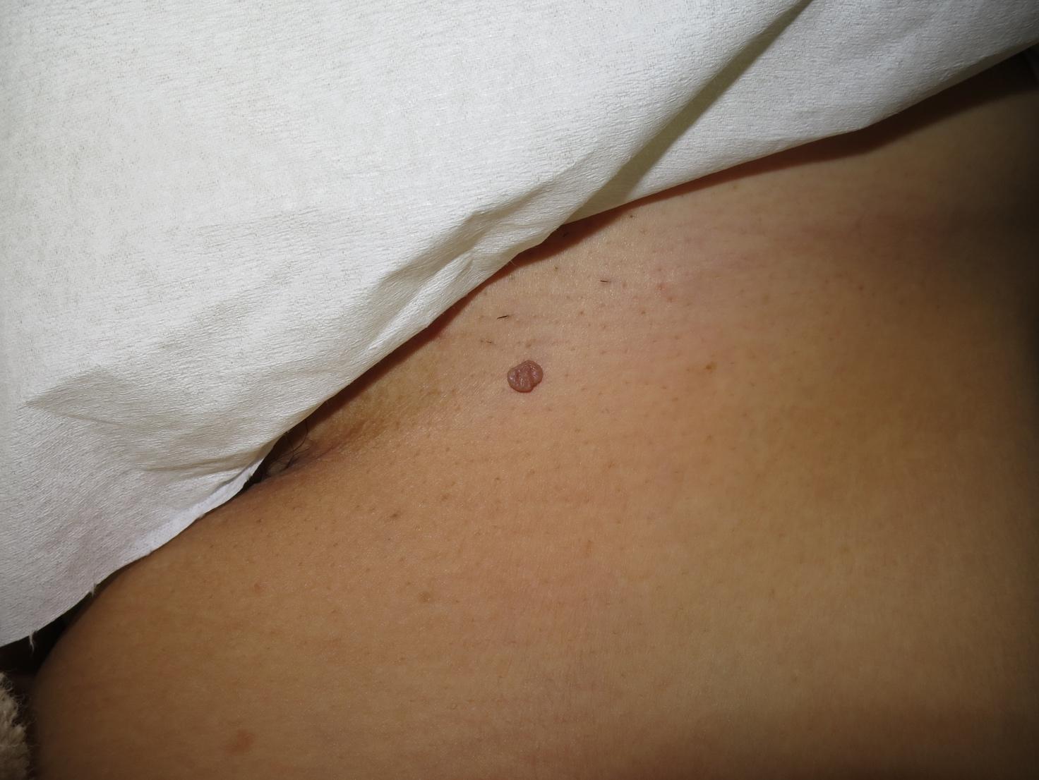 皮膚線維腫 Dermatofibroma– 医療法人 双英会 YUKI皮フ科形成外科一宮市時之島の皮膚科、形成外科