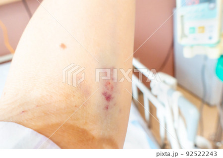 点滴でできた青あざ 内出血 を早く治す方法♡東京銀座スキンケアクリニック ドクターブログ