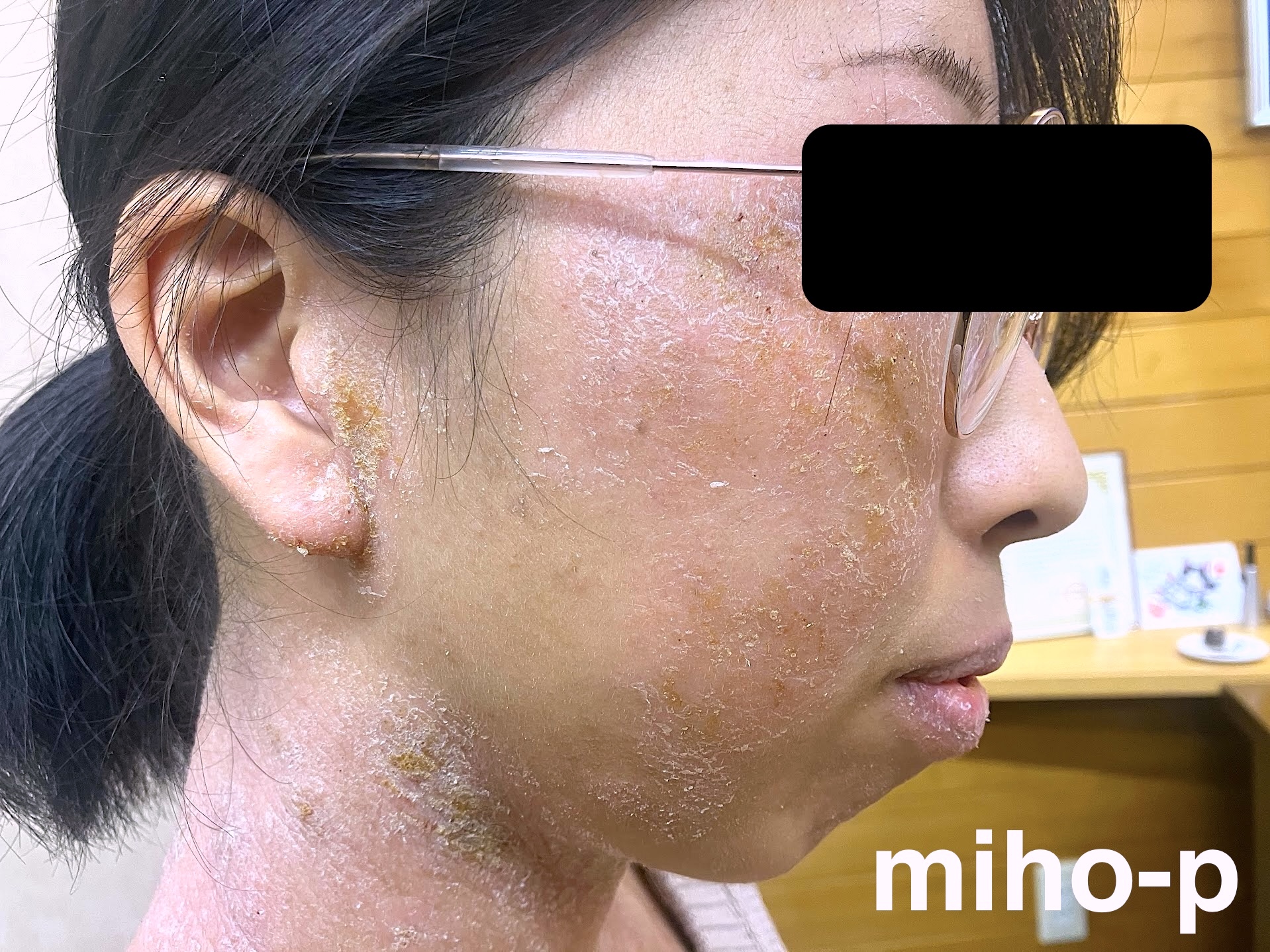 滲出液の黄色いかさぶたが消え見違える肌を取り戻した女性 症例：70アトピー脱ステロイド専門入院自然療法『ナチュラルクリニック21』