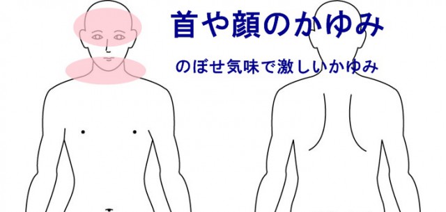アトピー性皮膚炎の症状・原因くすりと健康の情報局