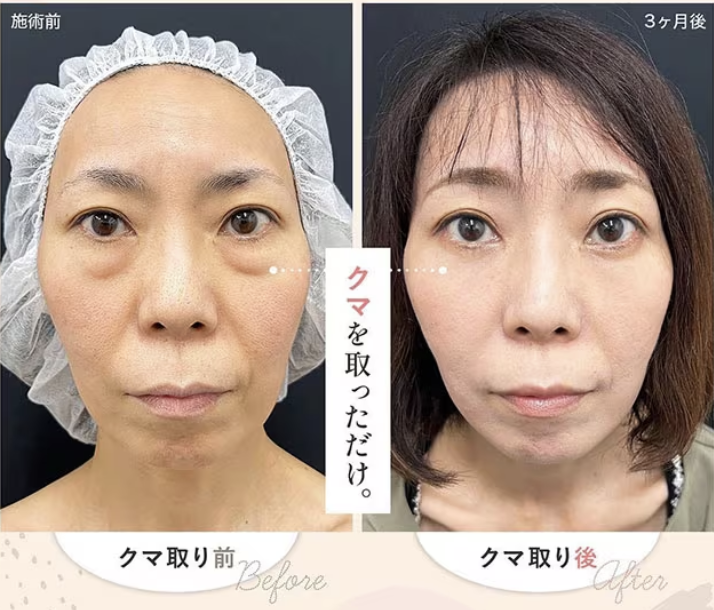 目の下のたるみ取り静岡中央クリニック・東京中央クリニック 公式 美容外科・美容皮膚科・形成外科