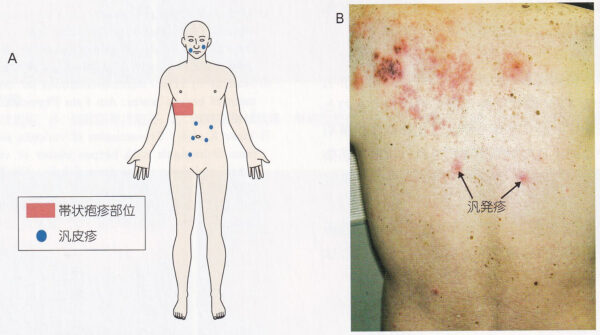 帯状疱疹とは？原因、症状、うつる？治療、ワクチンなど新宿駅前クリニック皮膚科