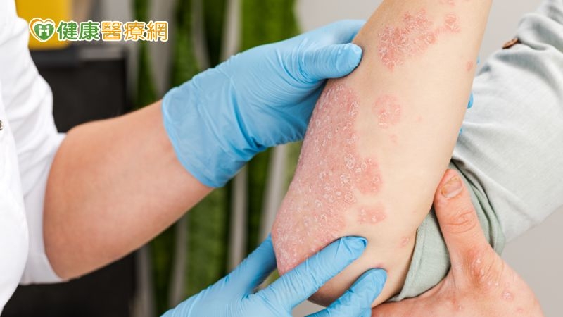 中醫可根治乾癬不再復發！５種症狀分析跟中醫治療成功案例- Dr.Syuan宣草集中醫診所乾癬脂漏性皮膚炎專家