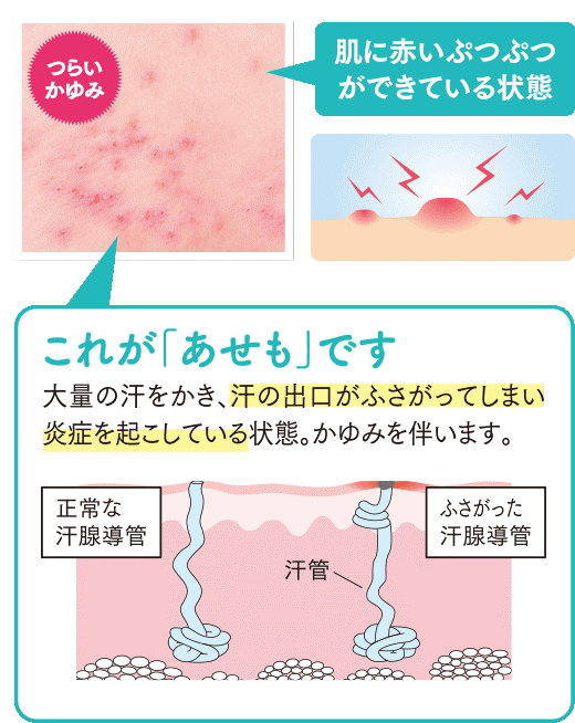 あせも服部皮膚科アレルギー科岡山市北区清心町の皮膚科・アレルギー科・美容皮膚科