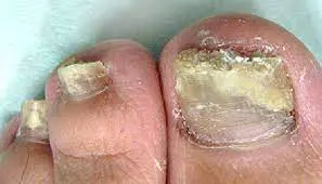 衝撃！ 糖尿病 これが意外な初期症状5選中山クリニック明石市の整形外科・再生医療・腱板断裂治療の専門医