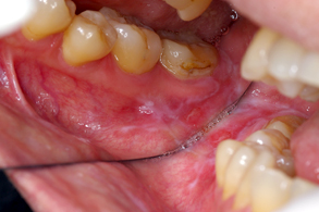 第5章 口腔粘膜の病変 扁平苔癬4 7