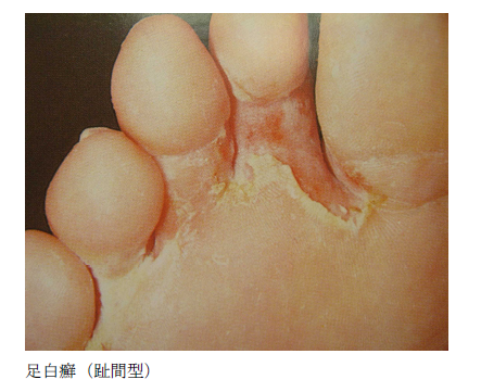 かかとの痛いガサガサの治し方クリームで保湿？削る？原因も解説健康肌スキンケア