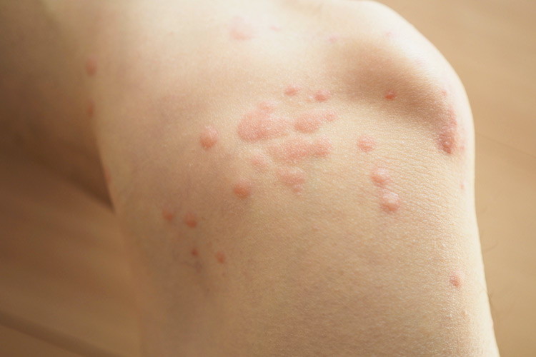 糖尿病と蕁麻疹 じんましん の関連とは？ドクターズチョイス健康情報集