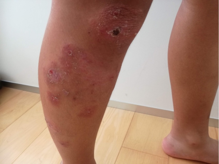 子どもの虫刺されで水ぶくれ？原因と対処法を解説 ベスタの小児科医が解説- 練馬の小児科365日診療 ベスタ アレルギー・夜尿症専門外来