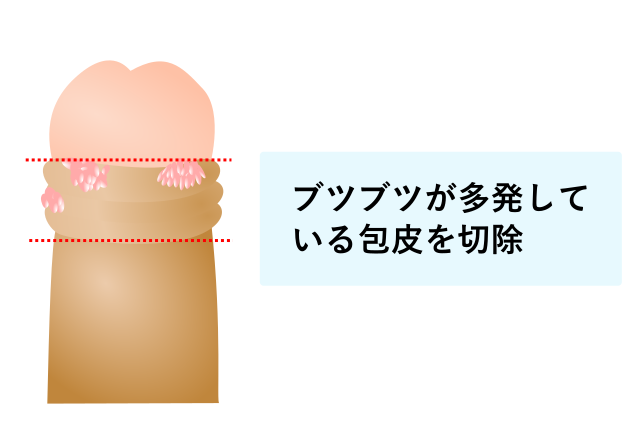 泌尿器科専門医 ドクター尾上の医療ブログ: コンジローマについて男性