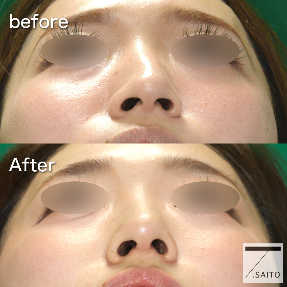 さいとう隆文_鼻・輪郭骨切り手術の症例が綺麗な美容外科医鷲鼻を残したい方の美容鼻整形 術後の腫れがまだ残る14日目。他院で前額ヒアルロン酸注入も受けておられます。美容外科鷲鼻鷲鼻修正顔面非対称顔のゆがみ斜鼻修正斜鼻修正術鼻翼縮小鼻翼