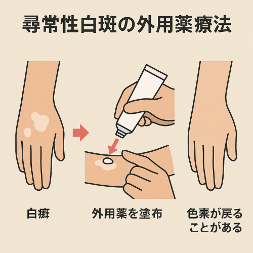 癜風 Tinea versicolor– 感染症 - 神戸きしだクリニック 神戸市中央区