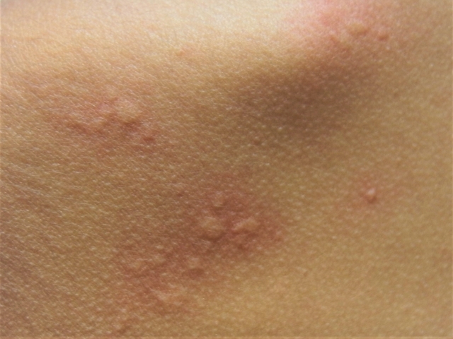 原因のコリを減らし続けていくと 発疹やアトピー性皮膚炎なども改善してきます ただし、ルート治療をただ受けるだけではなく自分と向き合う、自分に必要なことは何か？ 本当にいま必要なのか？ と常に問いかけ続けていくことが 自分自身を高めるために必要になってきます